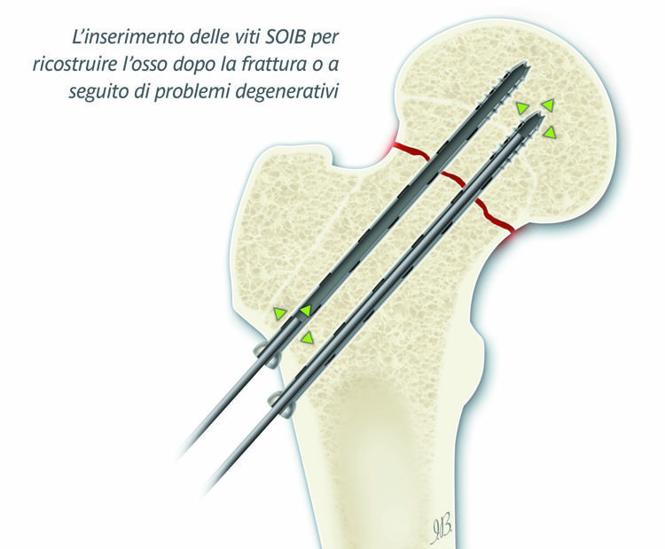 Medicina: G.B. Mangioni Hospital Lecco, percorso innovativo 'ortogeriatria'