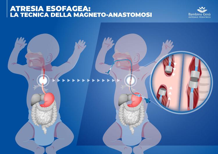 Al Bambino Gesù riparato esofago a 5 neonati grazie a magneti
