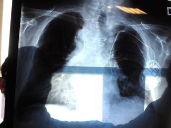 Fibrosi polmonari, diagnosi ancora difficile per pazienti con ‘fiato corto’