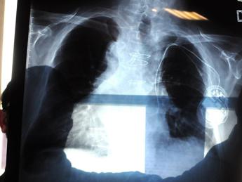 Cancro al polmone, ok Aifa a nuova terapia target
