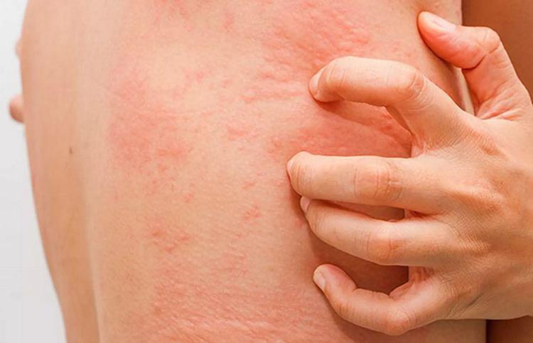 Orticaria cronica spontanea, come migliorare percorso di cura paziente