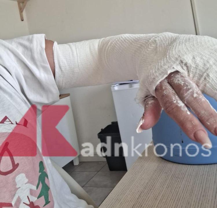 Maricetta Tirrito, la volontaria aggredita oggi a Tor Bella Monaca, mostra il braccio fratturato - Adnkronos