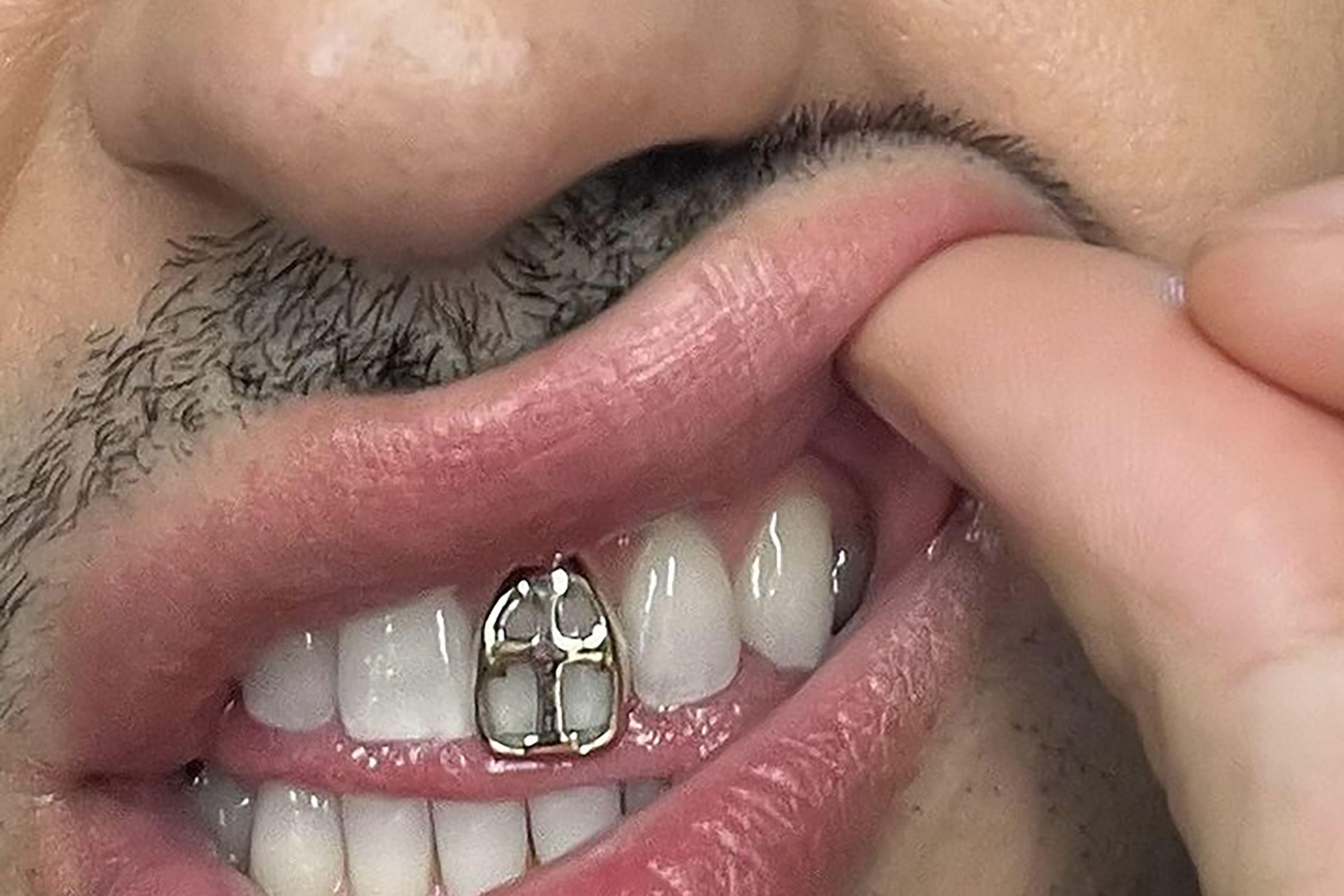 jewels-on-the-teeth-it-s-grillz-mania-what-you-need-to-know-and-the