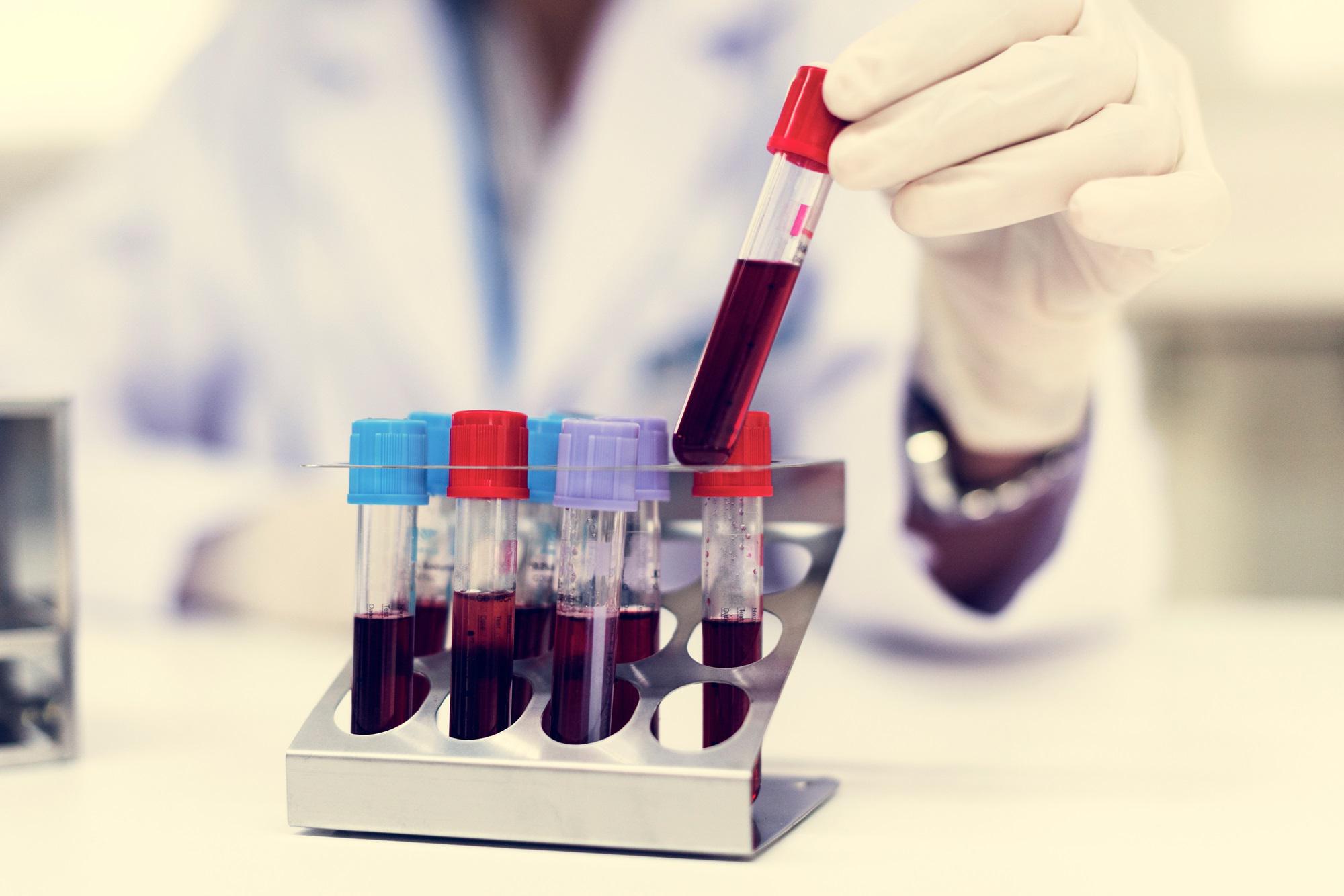 Parkinson - un test del sangue per scoprirlo 7 anni prima dei sintomi: la ricerca