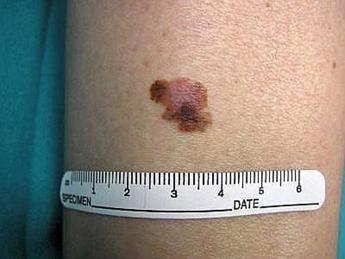 Melanoma, boom nei giovani: è il cancro più comune negli under 30