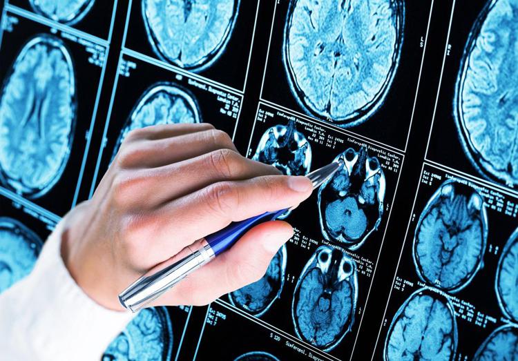 Scoperto meccanismo chiave dell'Alzheimer: speranza per diagnosi e cure