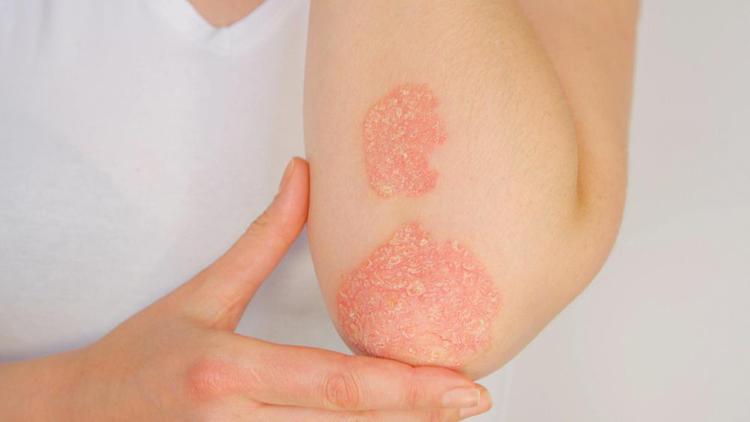 Psoriasi, ok Aifa a rimborsabilità nuova terapia orale