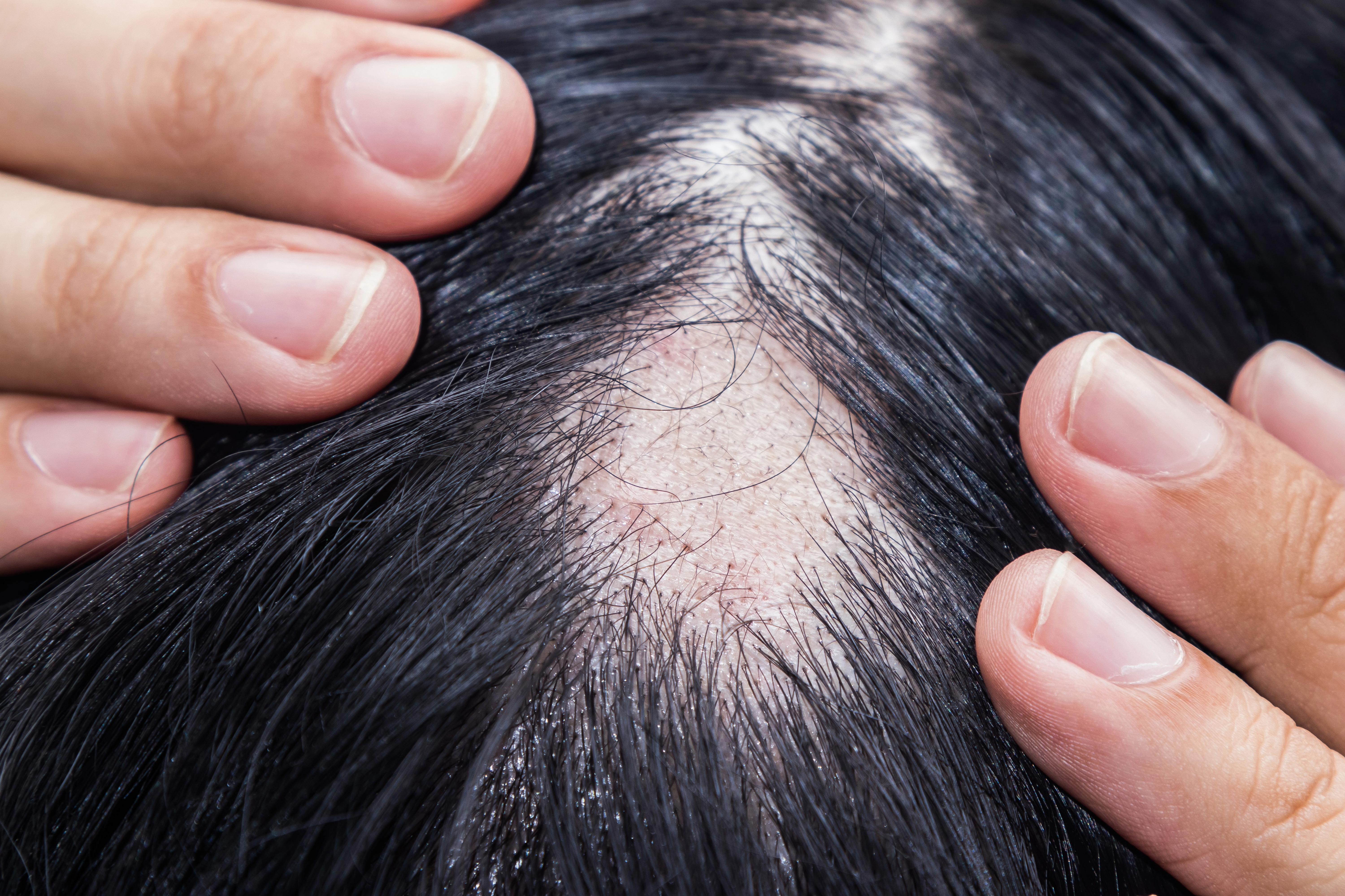 Alopecia areata - ok Aifa a rimborsabilità nuovo trattamento