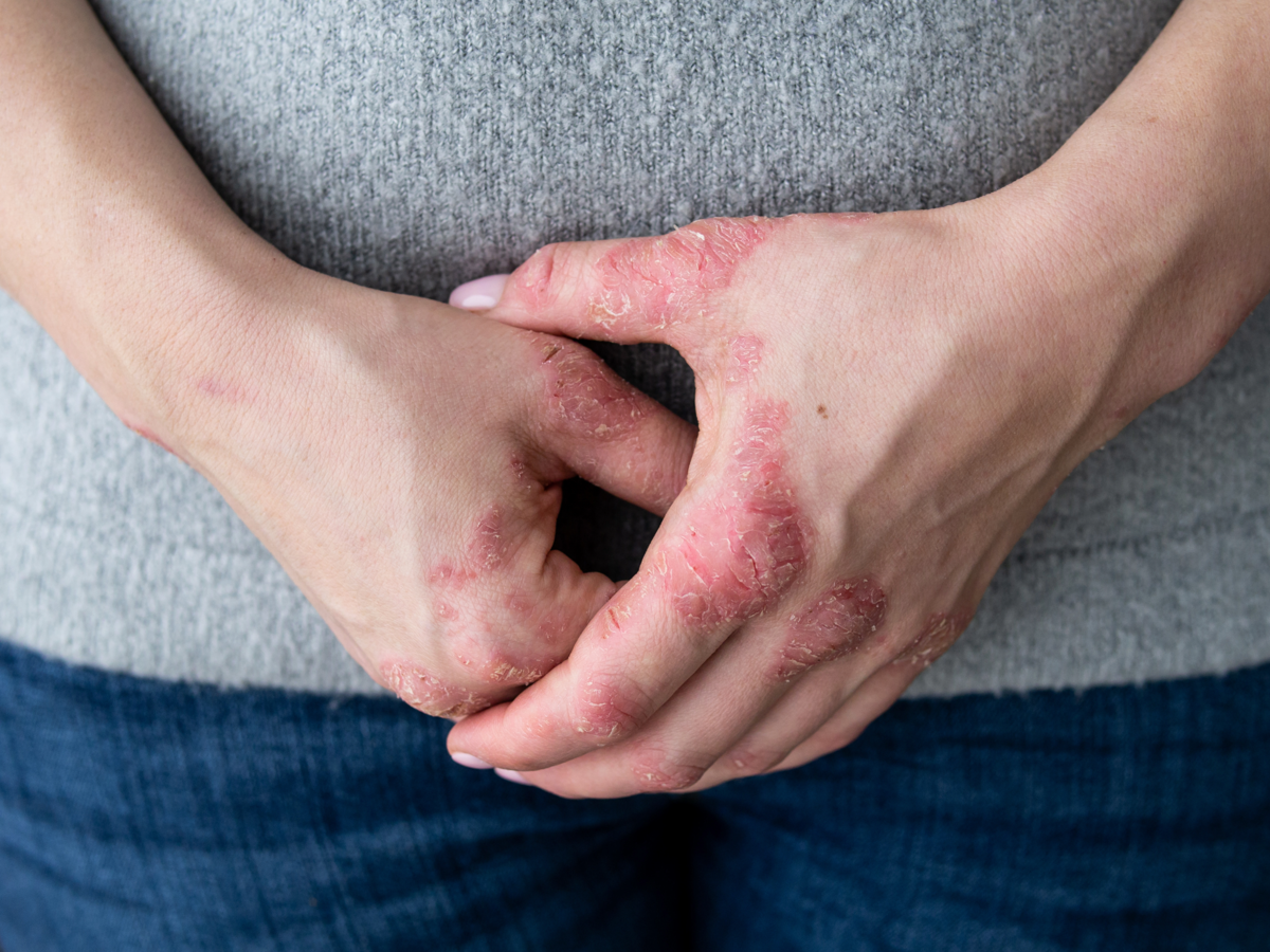 Farmaci, nuove cure per l'eczema cronico alle mani