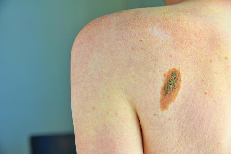 Tumori, +30% diagnosi melanoma in 2024, mai così tanti